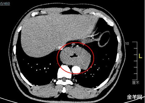肿瘤|在中肿切除巨大肿瘤后1天就下床走路，是因为......