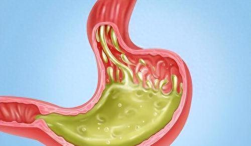 “烧心食物”排行榜,提醒:经常反酸的人,最好别吃,对胃好