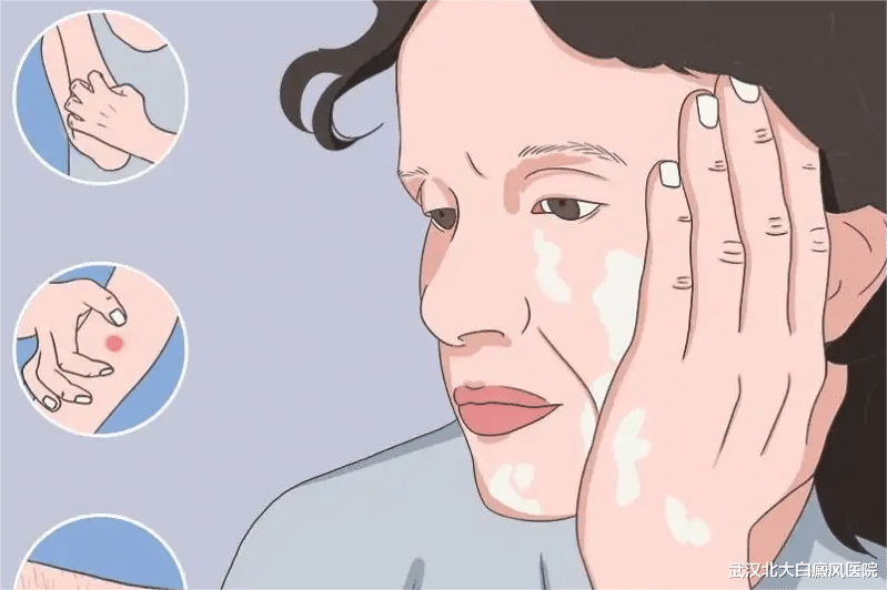 炎症会加重白癜风病情,生活中要小心这5种炎症