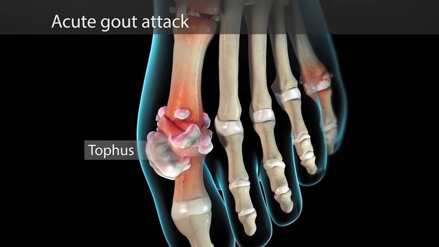 不只是关节疼痛：痛风可能引发的其他健康问题