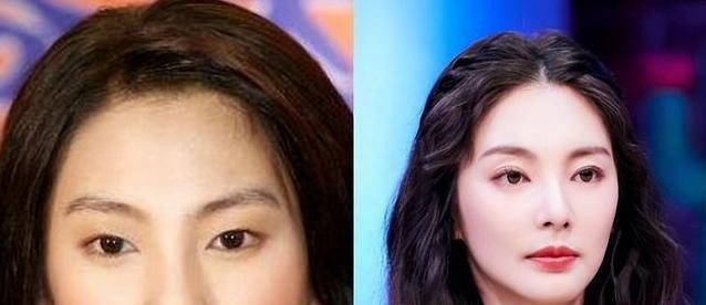 双眼皮别乱割，从景甜到戚薇，这些明星的“后遗症”出来了