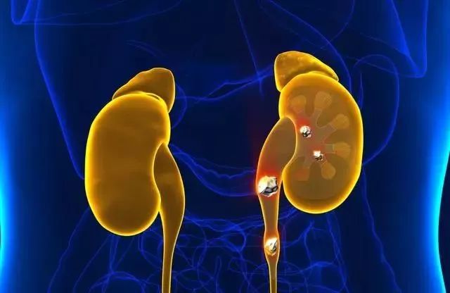 亚硝酸盐|肾结石吃什么食物最好?10种食物打败肾结石