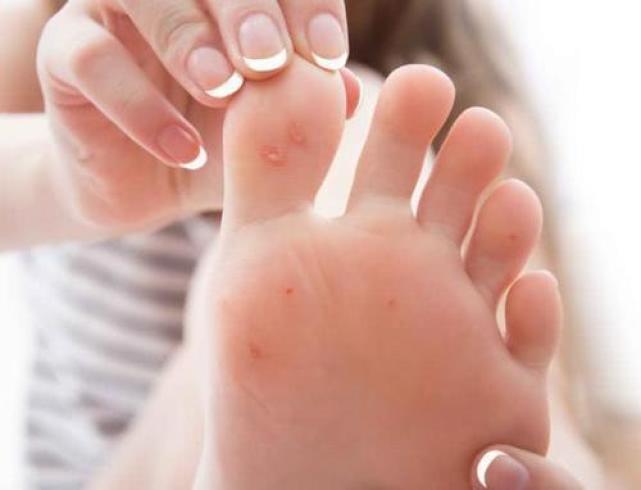 |脚后跟经常“开裂”是怎么回事?或与6个原因有关,早做了解