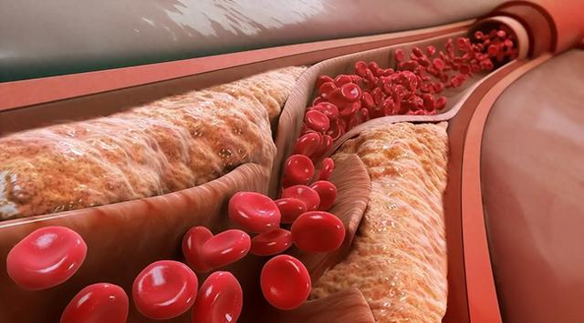 打一针管半年，这款“降脂药”有何秘诀？