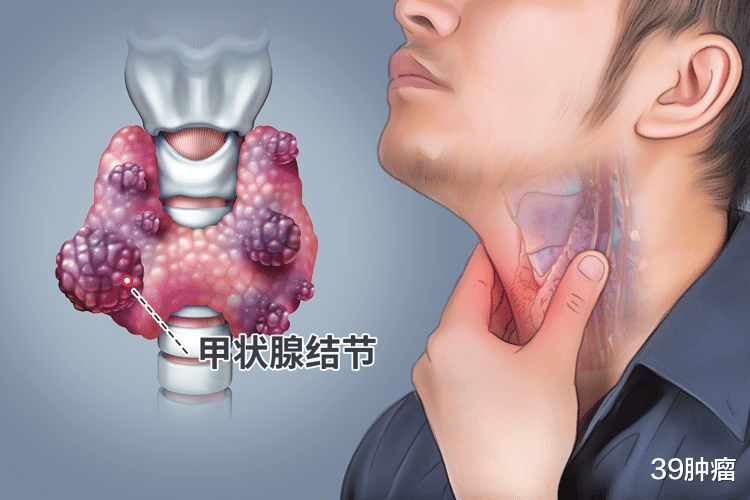 息肉、结节、囊肿、增生，哪些易癌变？哪些不用治？一文全告诉你