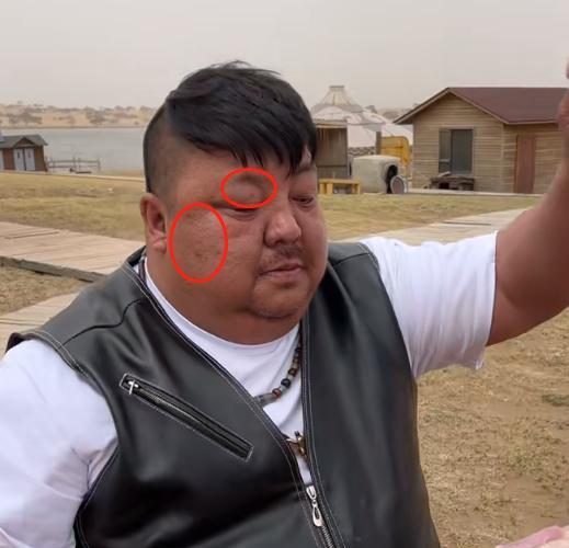 青菜|“羊亡爷”恩克不到半年吃110只羊,从不吃青菜,面色乌青疣扩散