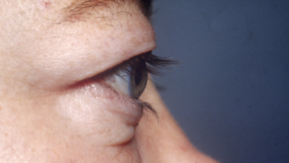 眼球突出|慢性甲状腺眼病新药4期试验数据积极，改善患者的眼球突出