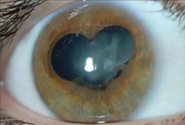 瞳孔突然变成三角形,是新冠后遗症?真相是……