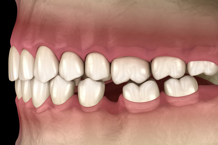 口腔健康|掉牙和寿命有关？60岁之后，牙齿剩多少颗才正常？看看您达标了吗