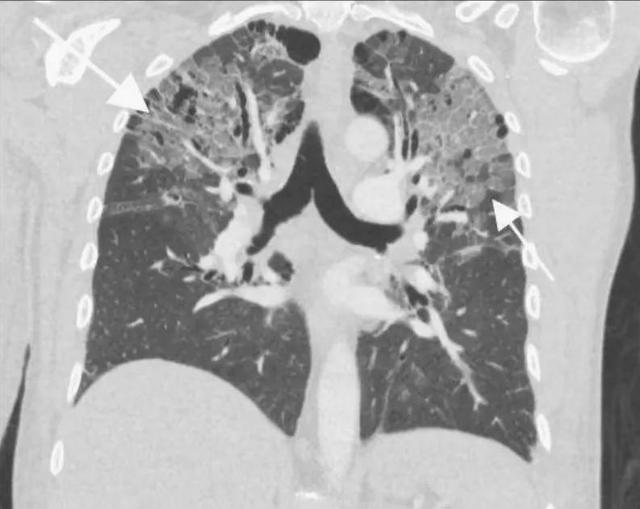 马甲线|骨折后呼吸困难，警惕肺脂肪栓塞︱病例分享