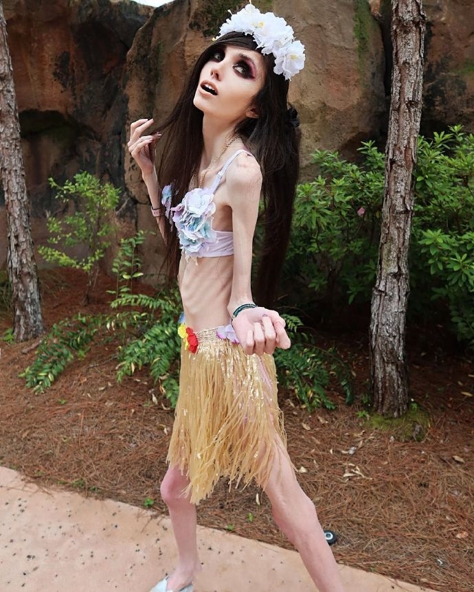 是愚蠢还是厌食？美国一网红以廋成名，瘦骨嶙峋，像纸片人一样