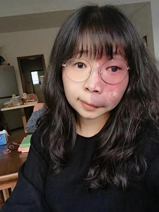 刘芳菲|我,因脸部有缺陷,找工作难,谈恋爱难,被嘲笑:将来谁会娶你