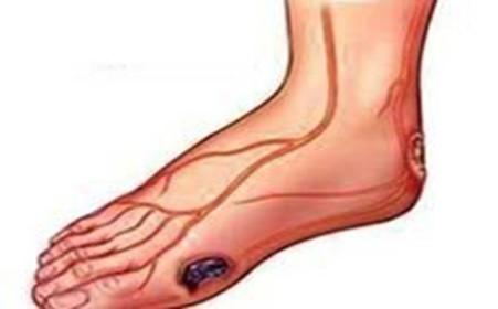 一个中成药搞定,糖尿病足病、带状疱疹后遗痛。