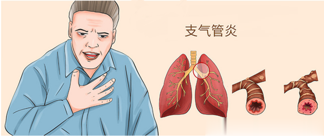 肺炎|支气管炎日常坚持做好这8大护理，可减少发作次数