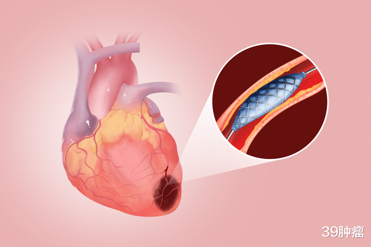 血栓来临，手脚先知？提醒：手脚若出现4个迹象，警惕血栓来袭