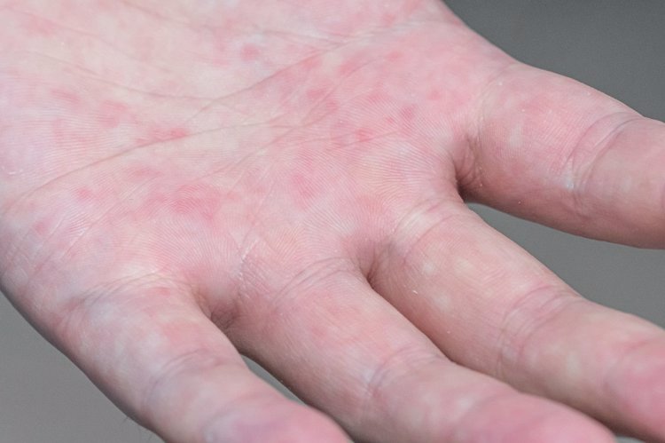 肝癌|欧美人爱喝酒的人多,为什么肝癌患者却比中国少?3个原因很现实