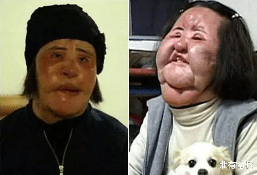 韩国女星整容上瘾注射大豆油,脸部取出8斤异物,最后孤独离世