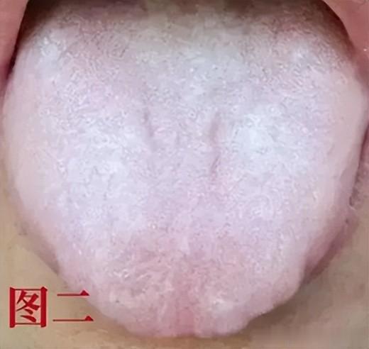 9种舌象9种体质,看镜子自查,学会了,不走弯路!