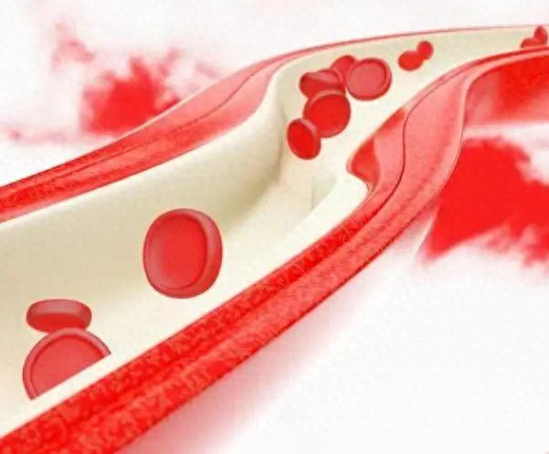 “血脂疫苗”正式启用了，每年只需注射2次，哪些人可以打呢？