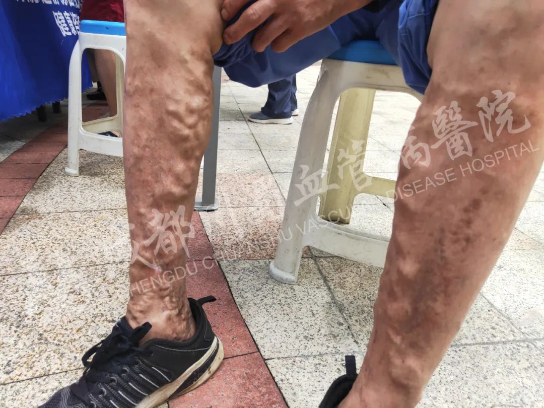 哪些职业更容易患上静脉曲张,你真的知道吗?