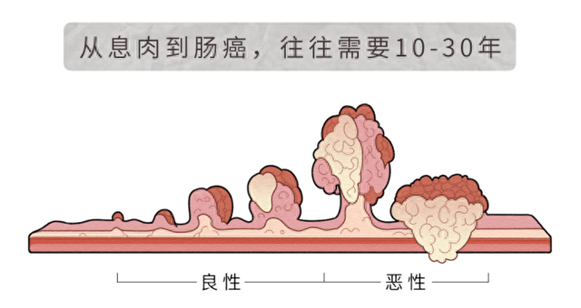 再次提醒：肠息肉不想变肠癌，3种东西尽量少吃，再馋也要克制住