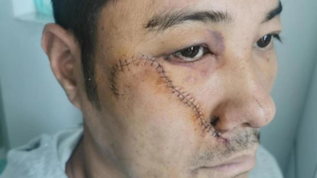 还有心理阴影！港男星去年遇袭后仍有余悸，被砍到脸皮脱落险丧命