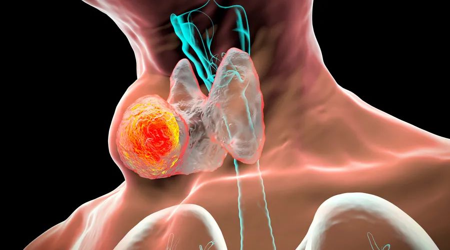 甲状腺结节|查出甲状腺结节后,要留意哪些健康问题?