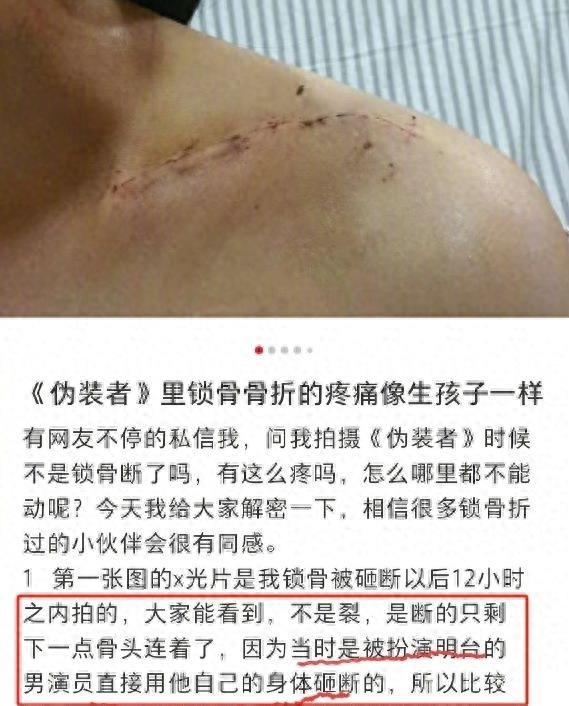 女星自曝被胡歌砸断锁骨,手术打七根钢钉,拍戏剧组封口不让外传