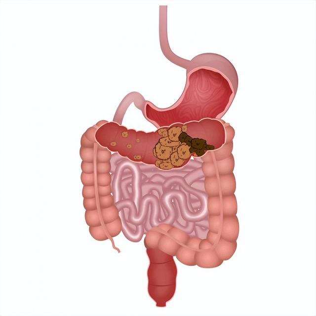 解决便秘顽疾,蔚通胶囊间歇性按摩肠道达6小时