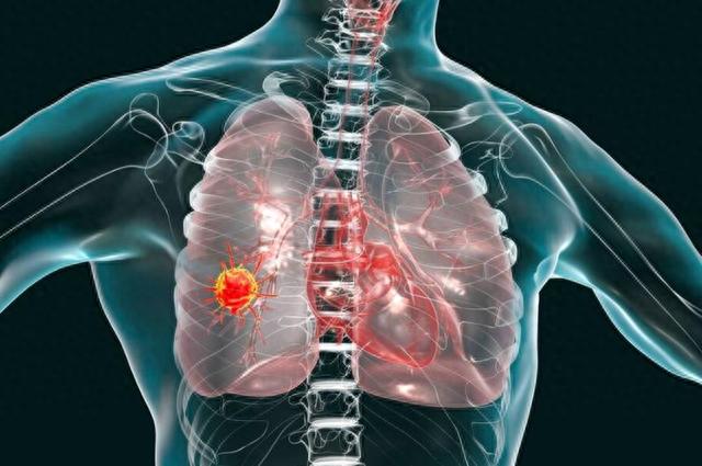 大蒜，是肺结节“催命符”吗？医生：不想结节癌变，少碰“2味”