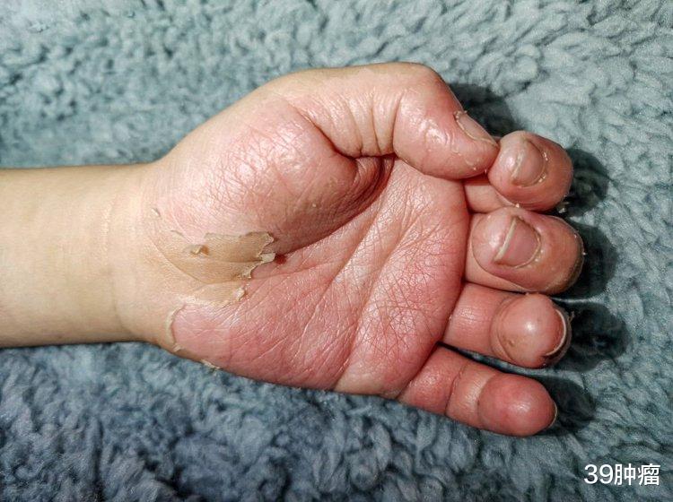 几块钱的维生素B2,竟是高血压“克星”?适当补充能有6大好处