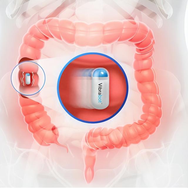 振动胶囊便秘者的高科技福音，通过振动刺激肠道神经