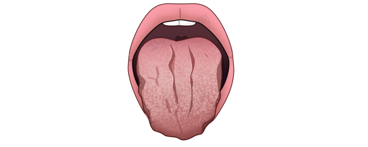 体内有癌,舌头先知?若舌头出现7种异常,当心癌症或疾病预警