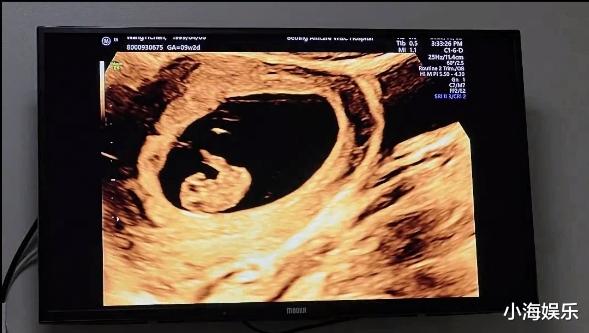 金龟子要做姥姥了!24岁女儿官宣怀孕晒B超,和男友已恋爱十年
