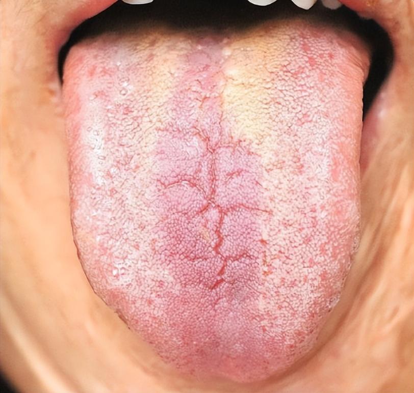 建议收藏——详细的舌象解析