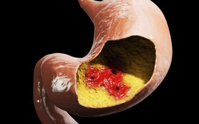 肝脏|为何胃癌在欧美是“罕见病”，在中国却高发？4个原因，早做了解