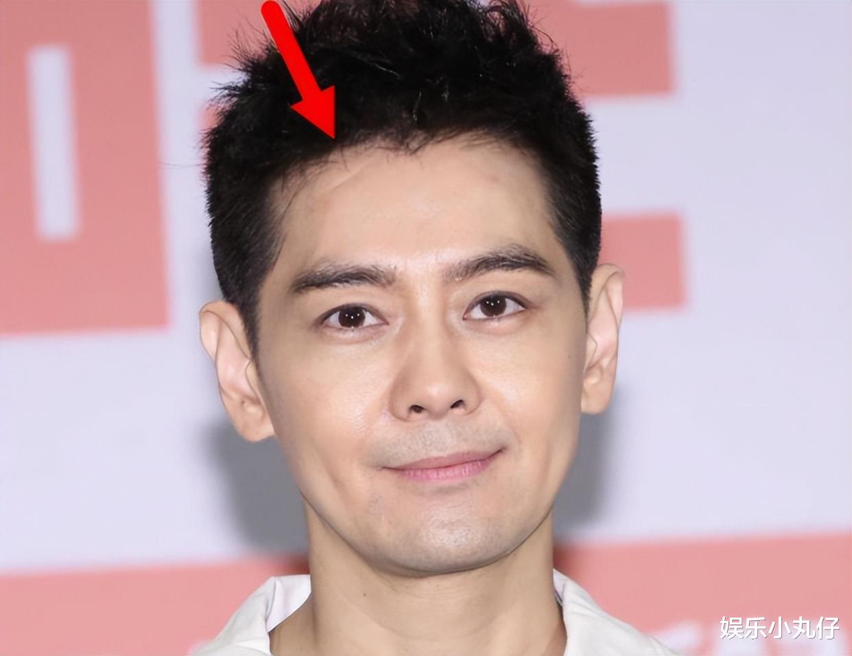 林志颖车祸后首露疤痕,面部凹陷皮肤分层似面具,一度眼睛险失明