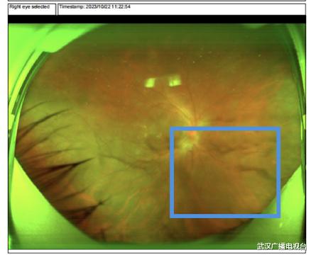 联合国糖尿病日 糖尿病患者应定期检查眼底