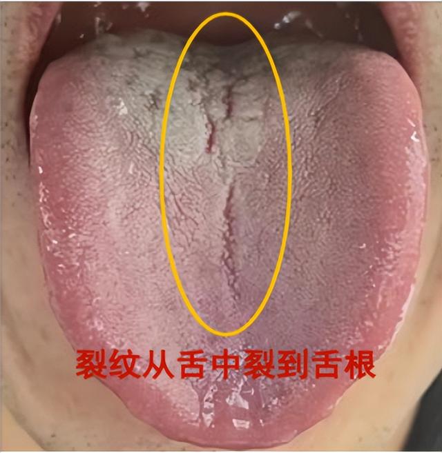 想法多，“敏感”、“一触即溃”一补就上火？原因就在舌头上！