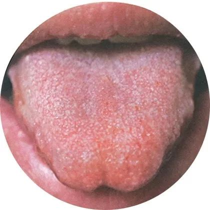 失眠|中医中的舌诊,了解吗