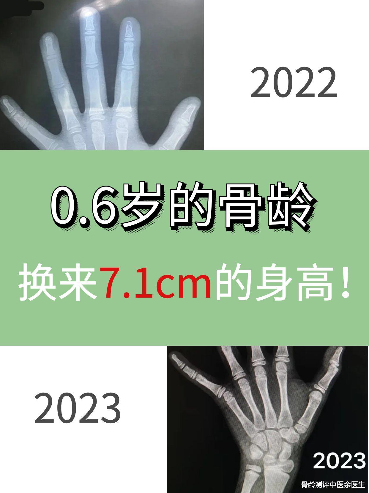 |0.6岁的骨龄换来7.1cm的身高！