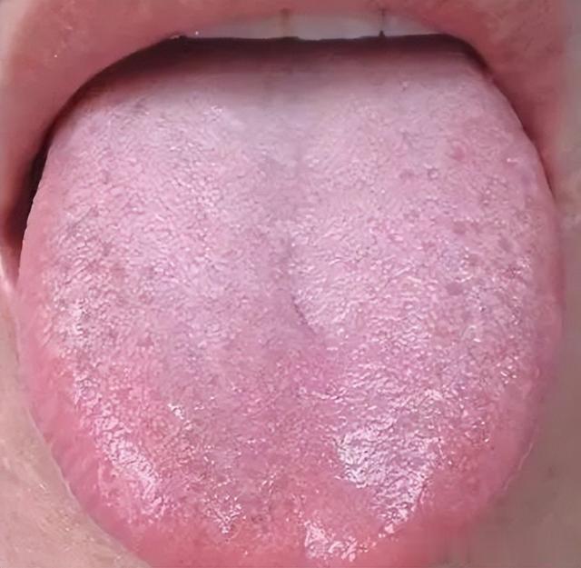 疾病|舌头中间有裂纹,边缘有齿痕等,是大病征兆?现在知道还不晚!