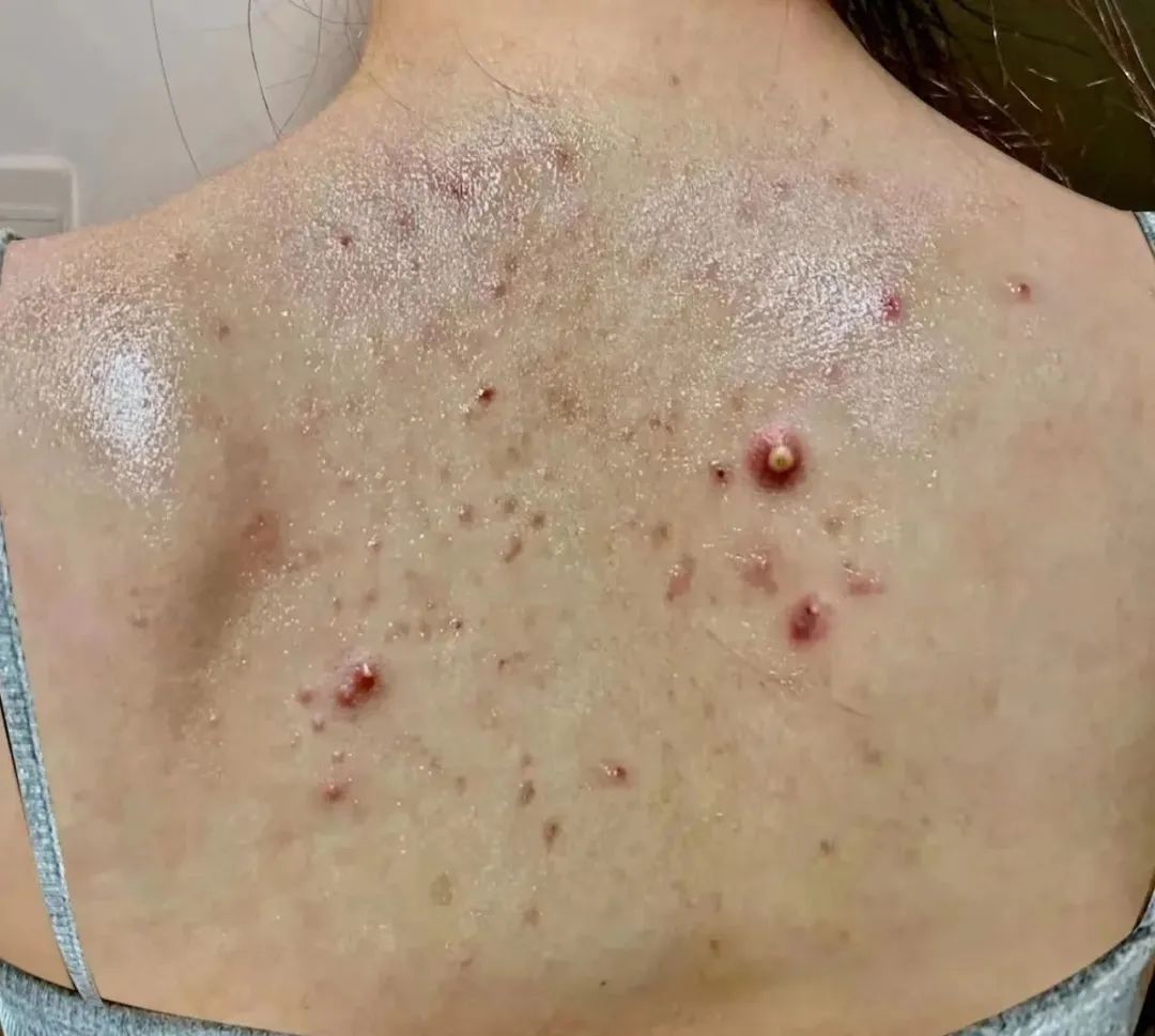 痘痘 全网公认3款口碑不俗的沐浴露，用完皮肤嫩滑不长痘！国货真靠谱！