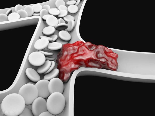哪些原因会引起肺栓塞？医生：和以下6个因素有关，要注意