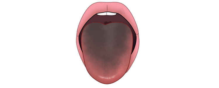 体内有癌,舌头先知?若舌头出现7种异常,当心癌症或疾病预警