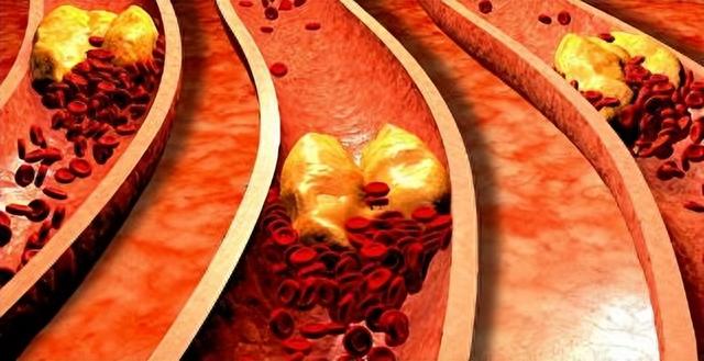 血液“稀释剂”被发现,柠檬水落榜,医生:坚持喝血管变通透