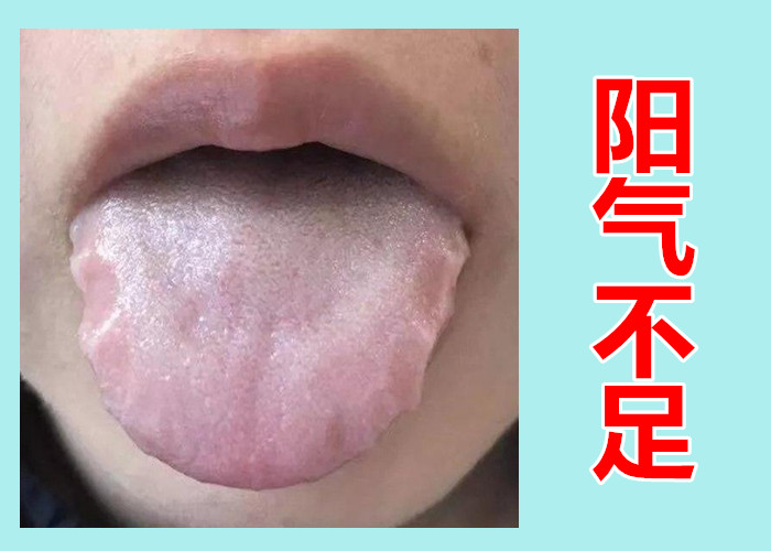 阳气不足舌先知！快来对照自己的舌头，看看自己阳虚到了哪一级？