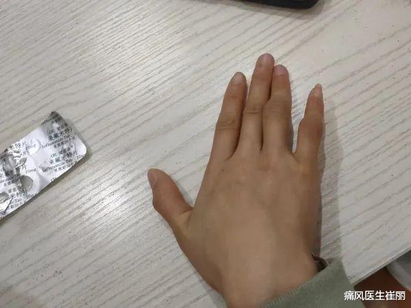 为什么不建议类风湿自己买药吃?