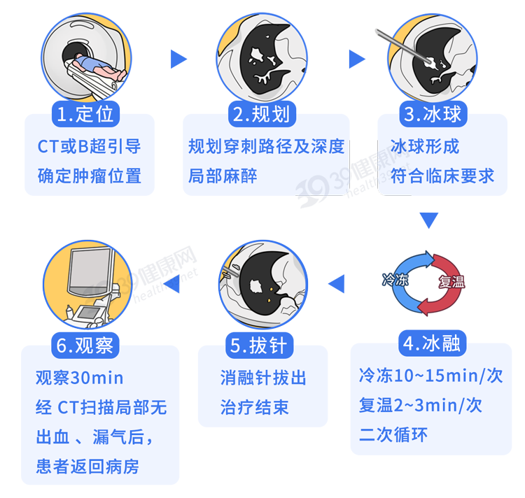 肿瘤|一针“冻死”癌细胞，被证实有效！损伤小恢复快，多种癌症可用