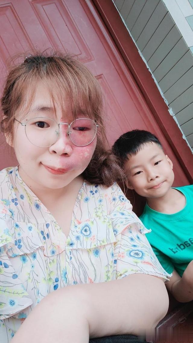 刘芳菲|我,因脸部有缺陷,找工作难,谈恋爱难,被嘲笑:将来谁会娶你